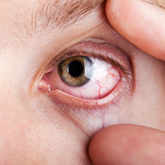 Dry Eye Assessment